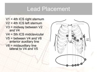 Lead Placement V1 = 4th ICS right sternum V2 = 4th ICS left sternum V3 = midway between V2 and V4 V4 = 5th ICS midclavicular V5 = between V4 and V6 anterior auxiliary line V6 = midauxillary line lateral to V4 and V5 