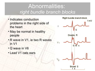 Abnormalities:  right   bundle branch blocks Indicates conduction problems in the right side of the heart May be normal in healthy people R wave in V1, ie two R waves in V1 Q wave in V6  Lead V1 cats ears 
