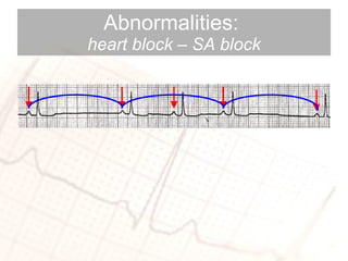 Abnormalities:  heart block – SA block 