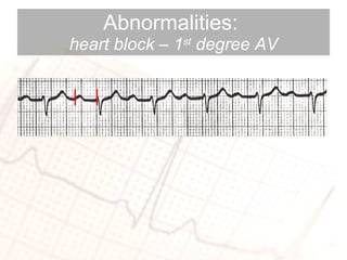 Abnormalities:  heart block – 1 st  degree AV 