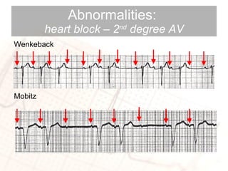 Abnormalities:  heart block – 2 nd  degree AV Wenkeback Mobitz 