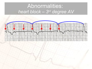 Abnormalities:  heart block – 3 rd  degree AV 