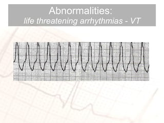 Abnormalities:  life threatening arrhythmias - VT 