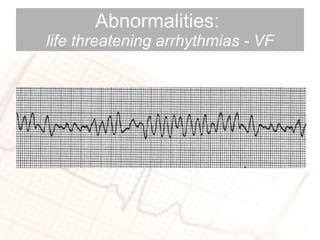 Abnormalities:  life threatening arrhythmias - VF 