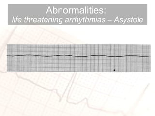 Abnormalities:  life threatening arrhythmias – Asystole 