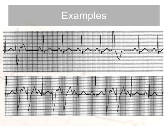 ECG interpretation: the basics | PPT