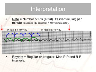 Rate  = Number of P’s (atrial) R’s (ventricular) per minute  (6 second [30 squares] X 10 = minute rate). Rhythm  = Regular or irregular. Map P-P and R-R intervals. Interpretation P rate: 8 x 10 = 80 R rate: 8 x 10 = 80 