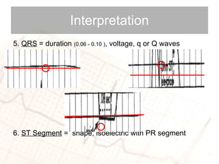 5.  QRS  = duration  (0.06 - 0.10 ) , voltage, q or Q waves 6.  ST Segment  =  shape, isoelectric with PR segment Interpretation 