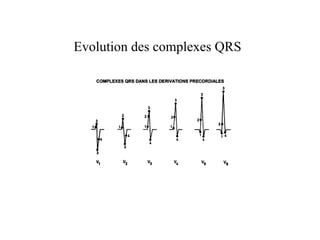 Evolution des complexes QRS
 