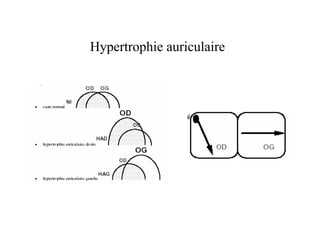Hypertrophie auriculaire
 