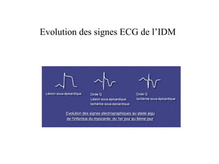 Evolution des signes ECG de l’IDM
 