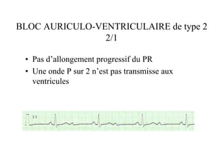 BLOC AURICULO-VENTRICULAIRE de type 2
                2/1

 • Pas d’allongement progressif du PR
 • Une onde P sur 2 n’est...
