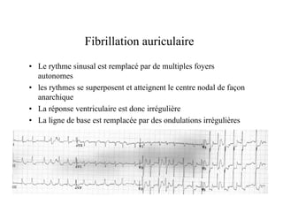Fibrillation auriculaire
• Le rythme sinusal est remplacé par de multiples foyers
  autonomes
• les rythmes se superposent...