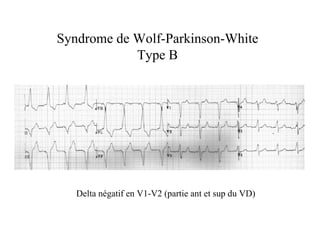 Syndrome de Wolf-Parkinson-White
            Type B




   Delta négatif en V1-V2 (partie ant et sup du VD)
 