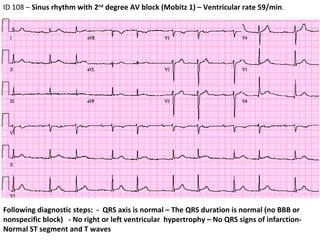 ECG #11 - ID 108 - 2nd degree AV block | PPT