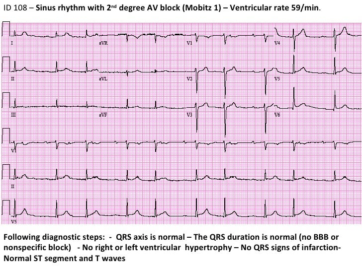 ECG 11 ID 108 2nd degree AV block