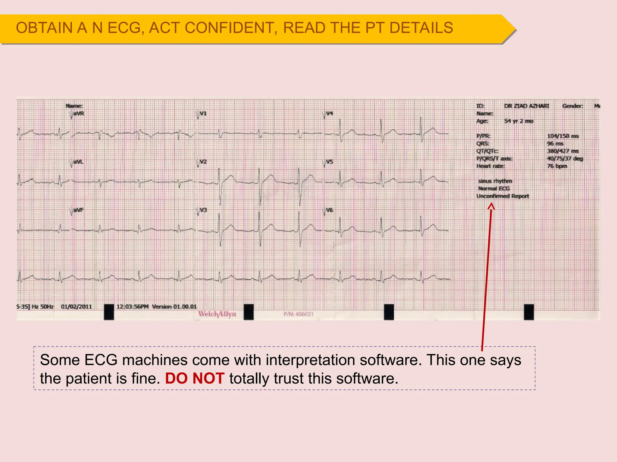 OBTAIN A N ECG, ACT CONFIDENT, READ THE PT DETAILS
Some ECG machines come with interpretation software. This one says
the patient is fine. DO NOT totally trust this software.
 