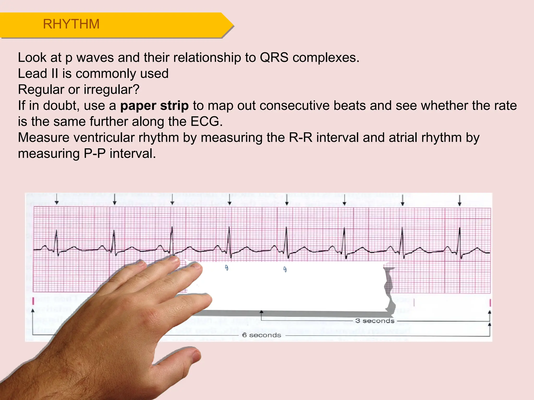 Look at p waves and their relationship to QRS complexes.
Lead II is commonly used
Regular or irregular?
If in doubt, use a paper strip to map out consecutive beats and see whether the rate
is the same further along the ECG.
Measure ventricular rhythm by measuring the R-R interval and atrial rhythm by
measuring P-P interval.
RHYTHM
 