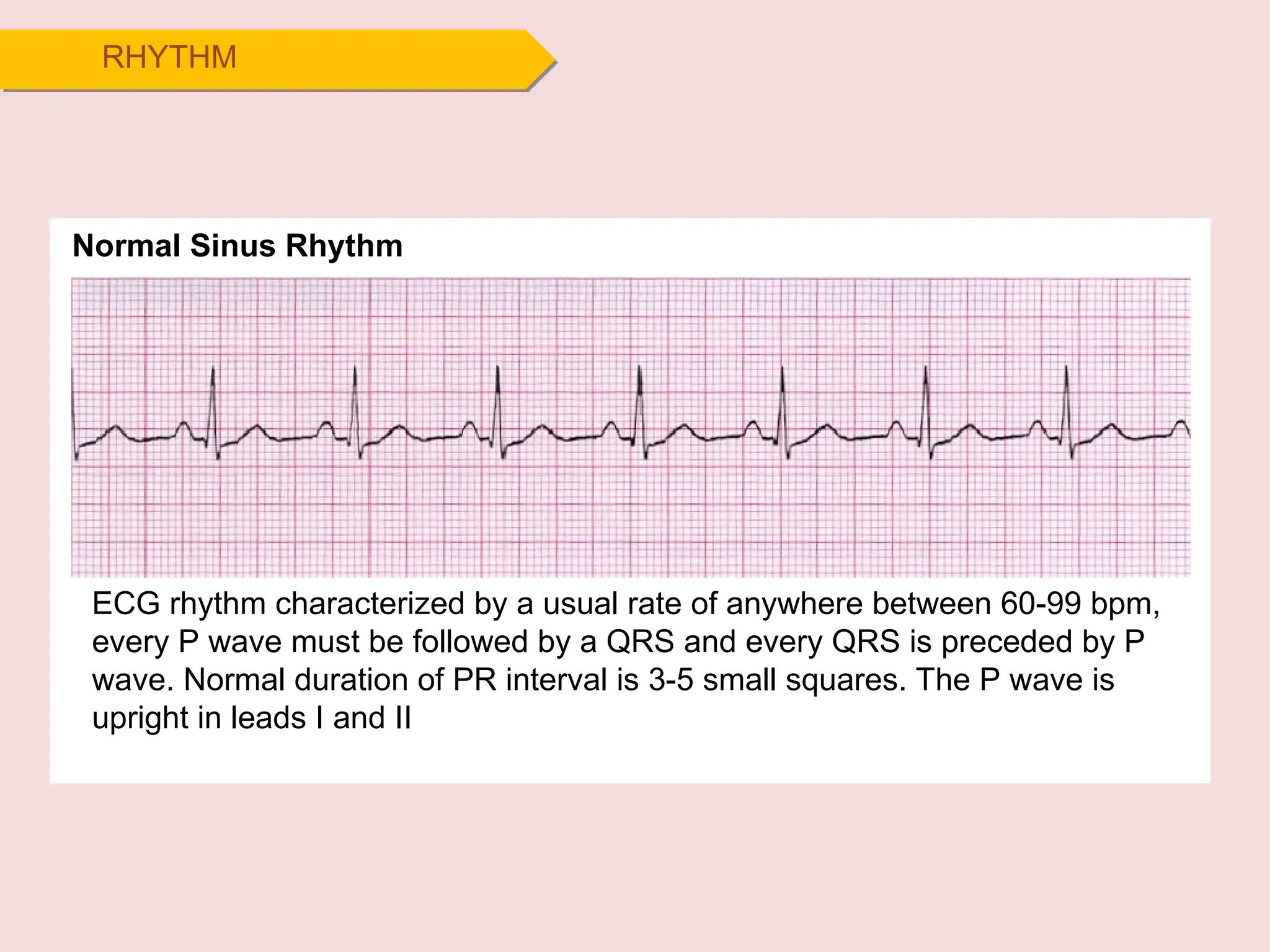 RHYTHM
ECG rhythm characterized by a usual rate of anywhere between 60-99 bpm,
every P wave must be followed by a QRS and every QRS is preceded by P
wave. Normal duration of PR interval is 3-5 small squares. The P wave is
upright in leads I and II
Normal Sinus Rhythm
 