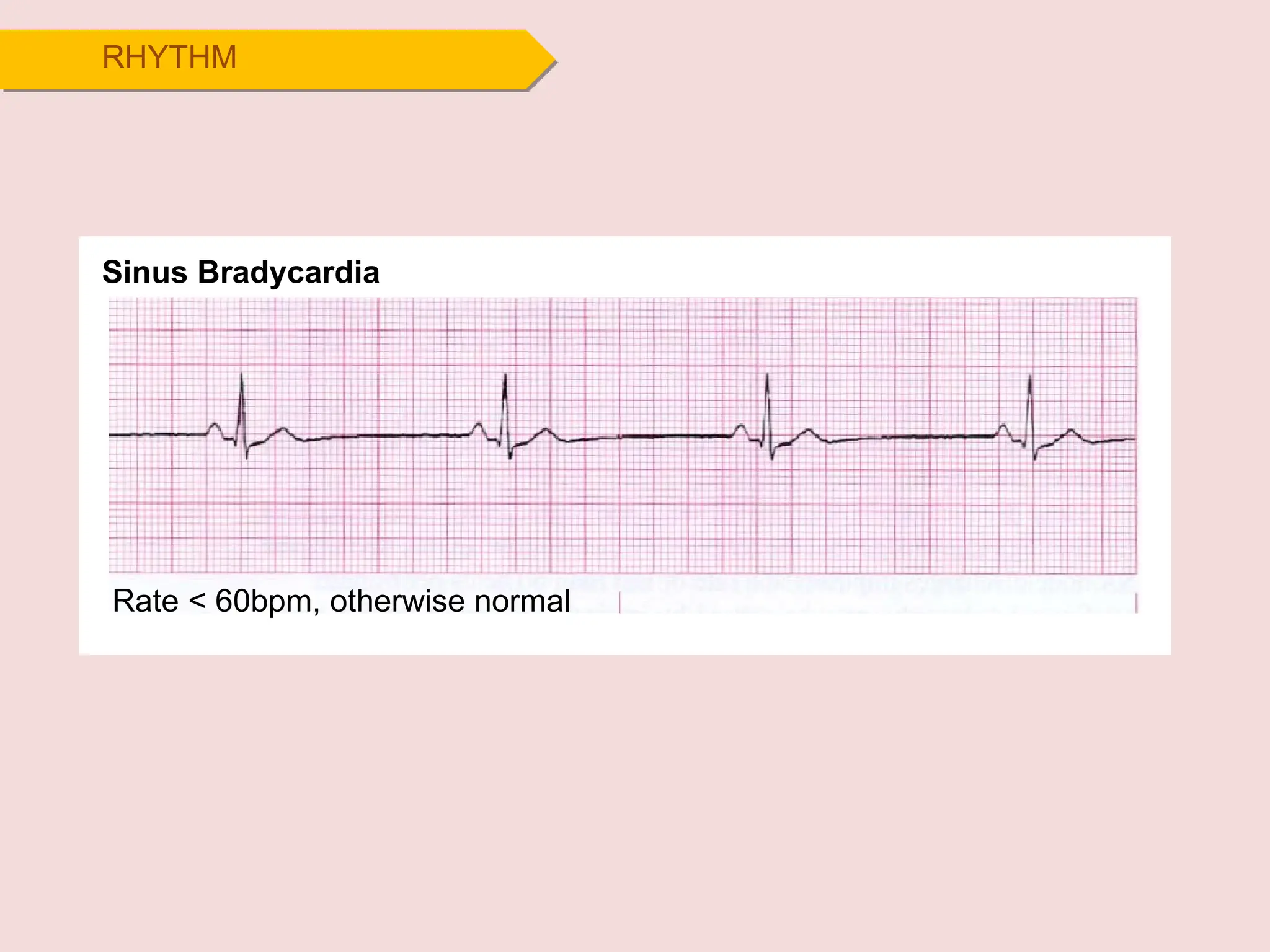 Sinus Bradycardia
RHYTHM
Rate < 60bpm, otherwise normal
 