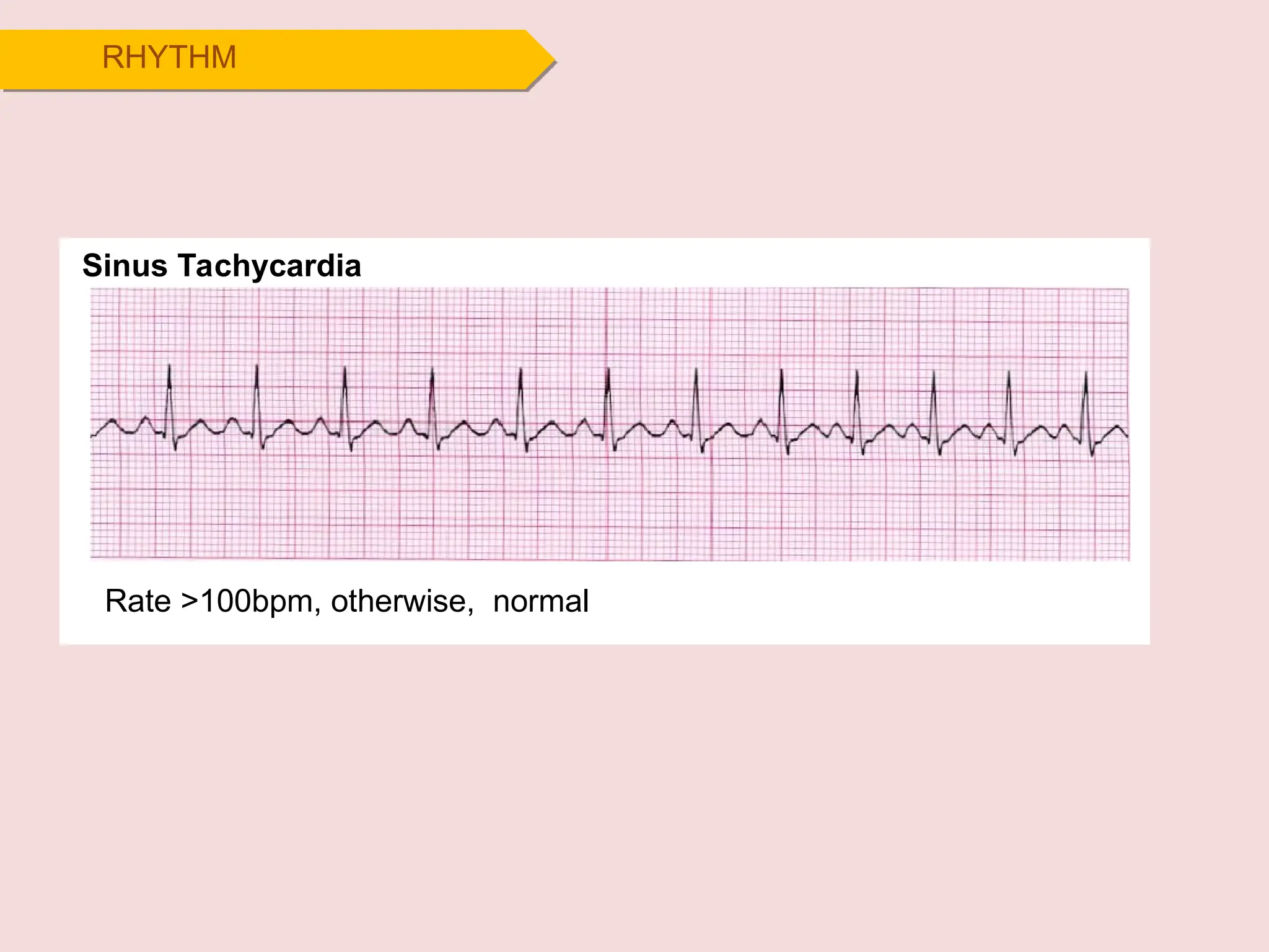 RHYTHM
Sinus Tachycardia
Rate >100bpm, otherwise, normal
 