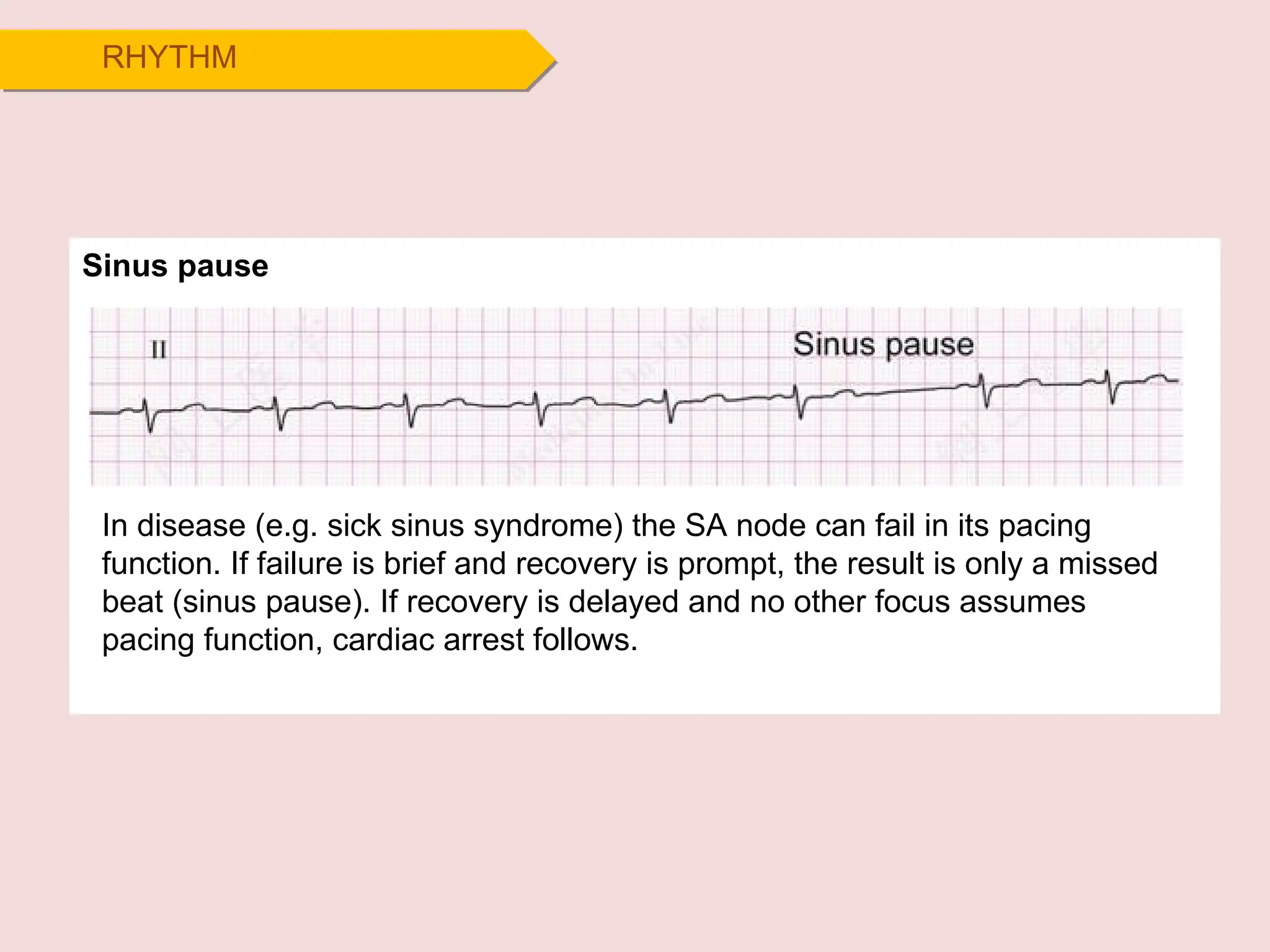RHYTHM
In disease (e.g. sick sinus syndrome) the SA node can fail in its pacing
function. If failure is brief and recovery is prompt, the result is only a missed
beat (sinus pause). If recovery is delayed and no other focus assumes
pacing function, cardiac arrest follows.
Sinus pause
 