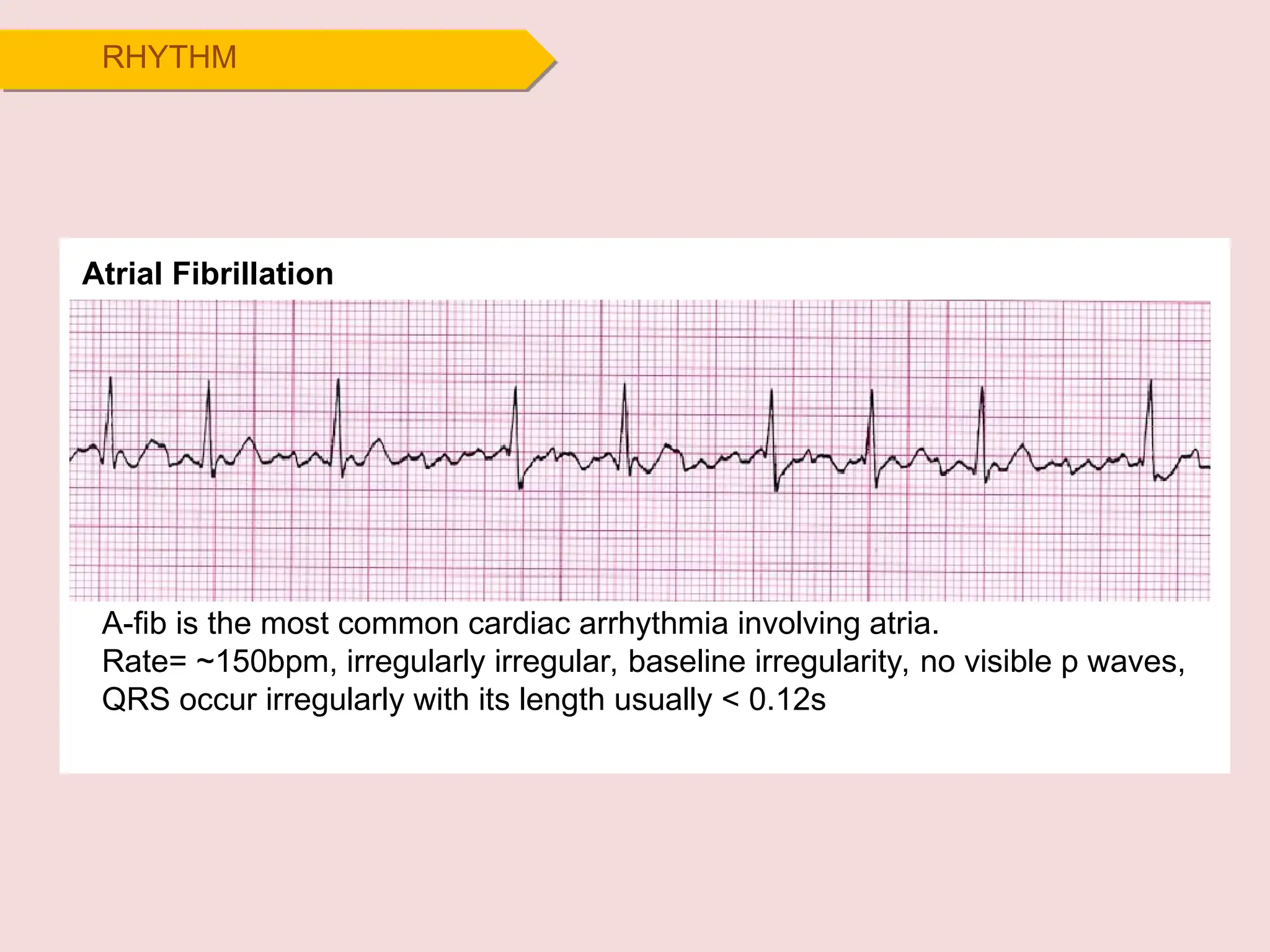 RHYTHM
Atrial Fibrillation
A-fib is the most common cardiac arrhythmia involving atria.
Rate= ~150bpm, irregularly irregular, baseline irregularity, no visible p waves,
QRS occur irregularly with its length usually < 0.12s
 