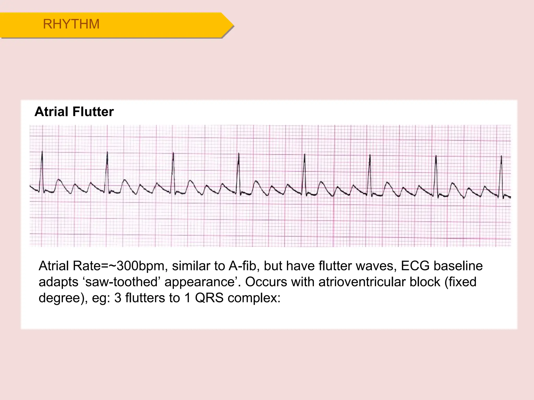 RHYTHM
Atrial Flutter
Atrial Rate=~300bpm, similar to A-fib, but have flutter waves, ECG baseline
adapts ‘saw-toothed’ appearance’. Occurs with atrioventricular block (fixed
degree), eg: 3 flutters to 1 QRS complex:
 