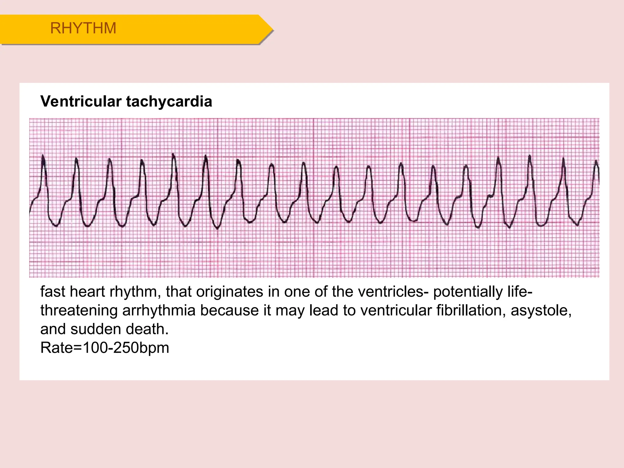 RHYTHM
Ventricular tachycardia
fast heart rhythm, that originates in one of the ventricles- potentially life-
threatening arrhythmia because it may lead to ventricular fibrillation, asystole,
and sudden death.
Rate=100-250bpm
 