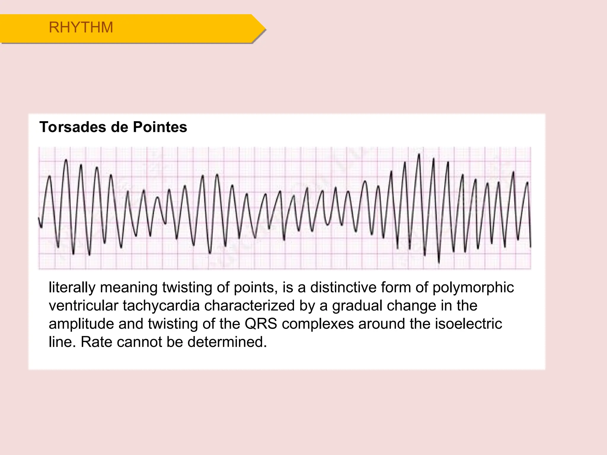 RHYTHM
Torsades de Pointes
literally meaning twisting of points, is a distinctive form of polymorphic
ventricular tachycardia characterized by a gradual change in the
amplitude and twisting of the QRS complexes around the isoelectric
line. Rate cannot be determined.
 