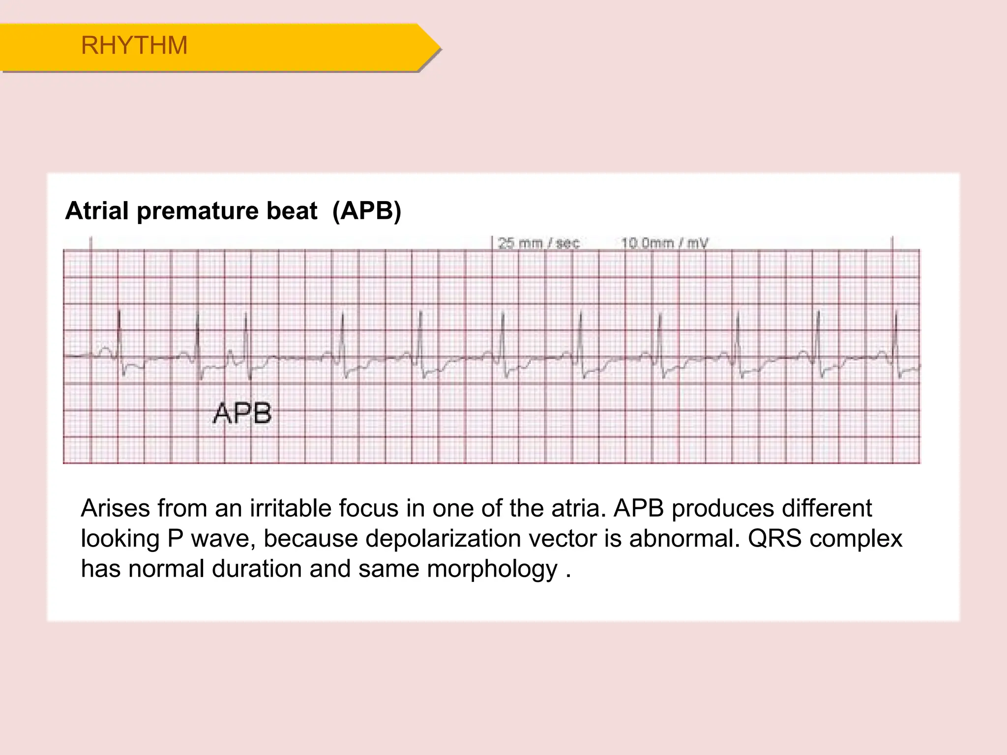 RHYTHM
Atrial premature beat (APB)
Arises from an irritable focus in one of the atria. APB produces different
looking P wave, because depolarization vector is abnormal. QRS complex
has normal duration and same morphology .
 