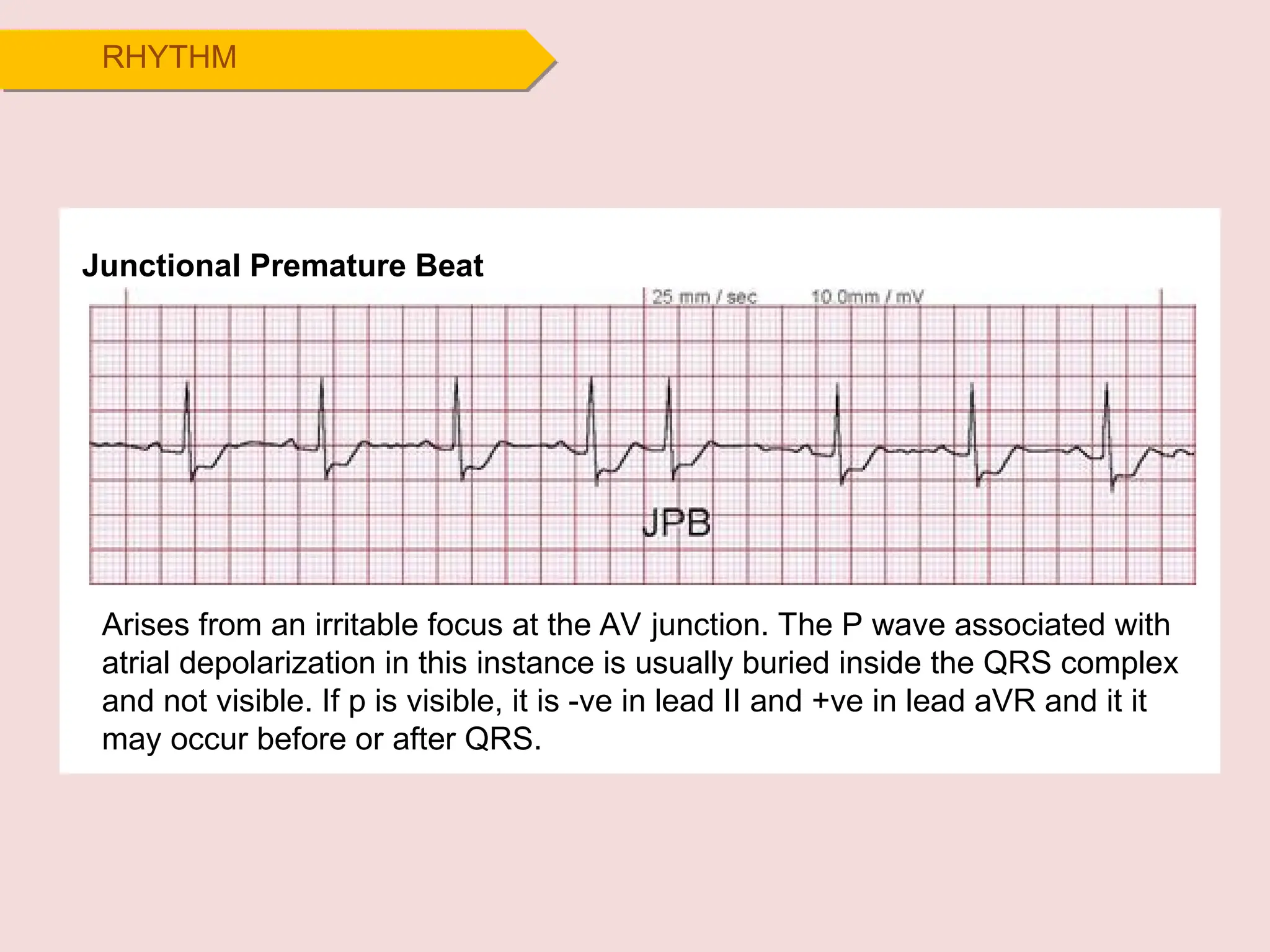 RHYTHM
Junctional Premature Beat
Arises from an irritable focus at the AV junction. The P wave associated with
atrial depolarization in this instance is usually buried inside the QRS complex
and not visible. If p is visible, it is -ve in lead II and +ve in lead aVR and it it
may occur before or after QRS.
 