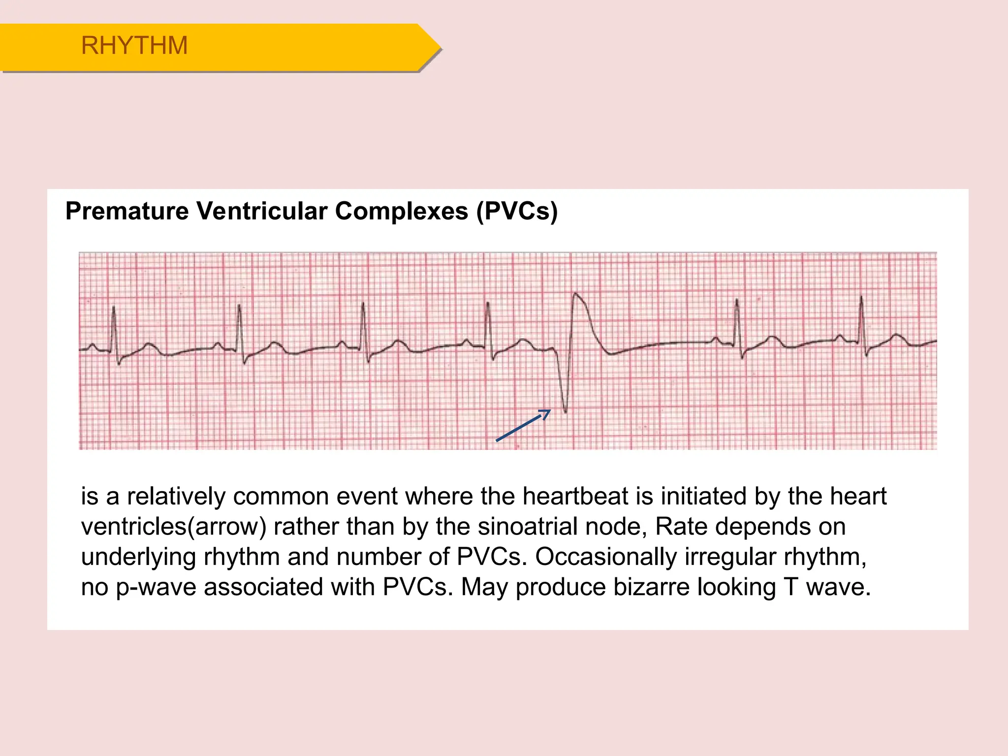 RHYTHM
Premature Ventricular Complexes (PVCs)
is a relatively common event where the heartbeat is initiated by the heart
ventricles(arrow) rather than by the sinoatrial node, Rate depends on
underlying rhythm and number of PVCs. Occasionally irregular rhythm,
no p-wave associated with PVCs. May produce bizarre looking T wave.
 