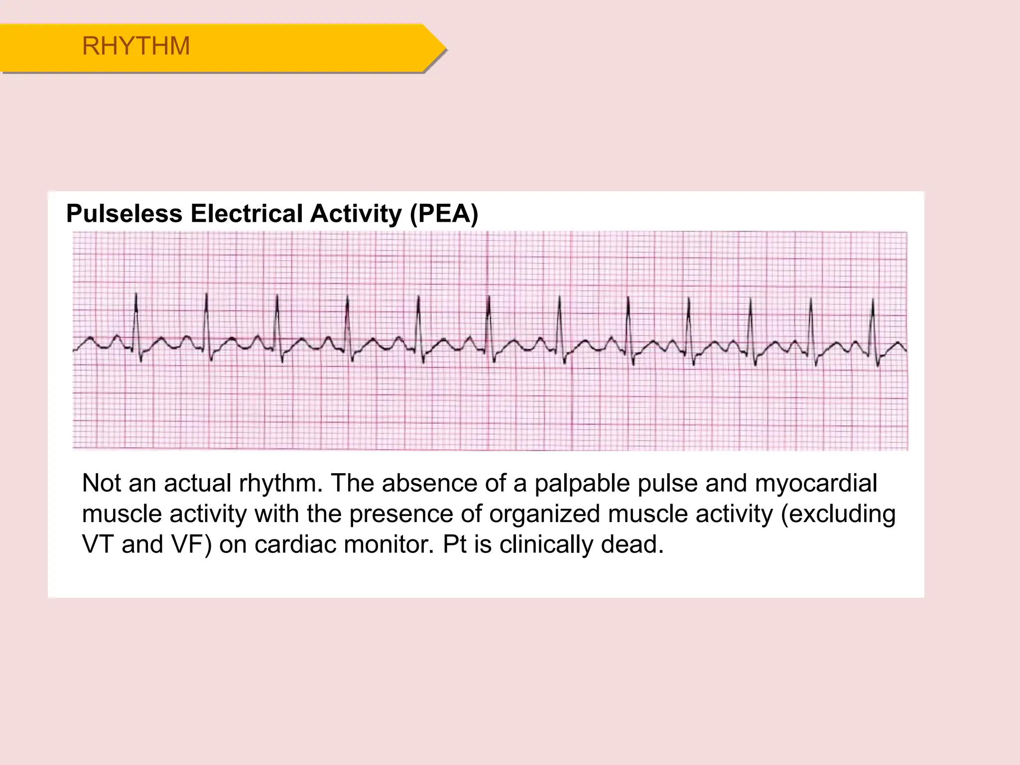 RHYTHM
Pulseless Electrical Activity (PEA)
Not an actual rhythm. The absence of a palpable pulse and myocardial
muscle activity with the presence of organized muscle activity (excluding
VT and VF) on cardiac monitor. Pt is clinically dead.
 