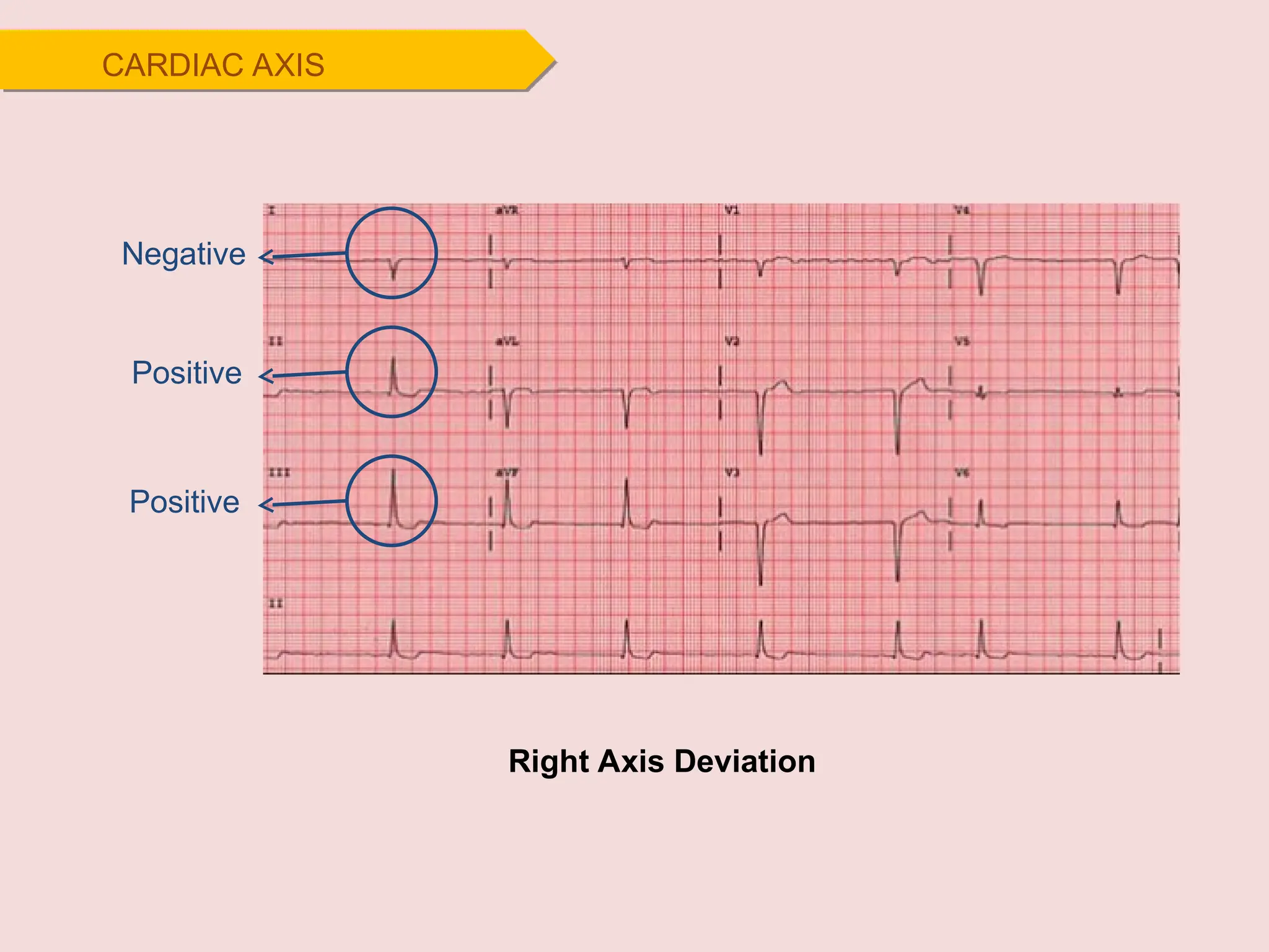 Negative
Positive
Positive
Right Axis Deviation
CARDIAC AXIS
 