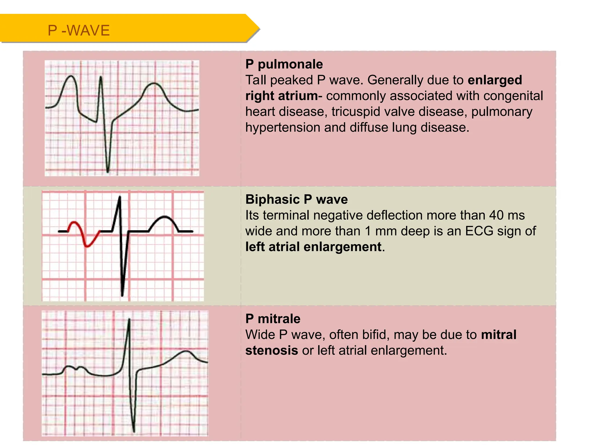 P -WAVE
P pulmonale
Tall peaked P wave. Generally due to enlarged
right atrium- commonly associated with congenital
heart disease, tricuspid valve disease, pulmonary
hypertension and diffuse lung disease.
Biphasic P wave
Its terminal negative deflection more than 40 ms
wide and more than 1 mm deep is an ECG sign of
left atrial enlargement.
P mitrale
Wide P wave, often bifid, may be due to mitral
stenosis or left atrial enlargement.
 