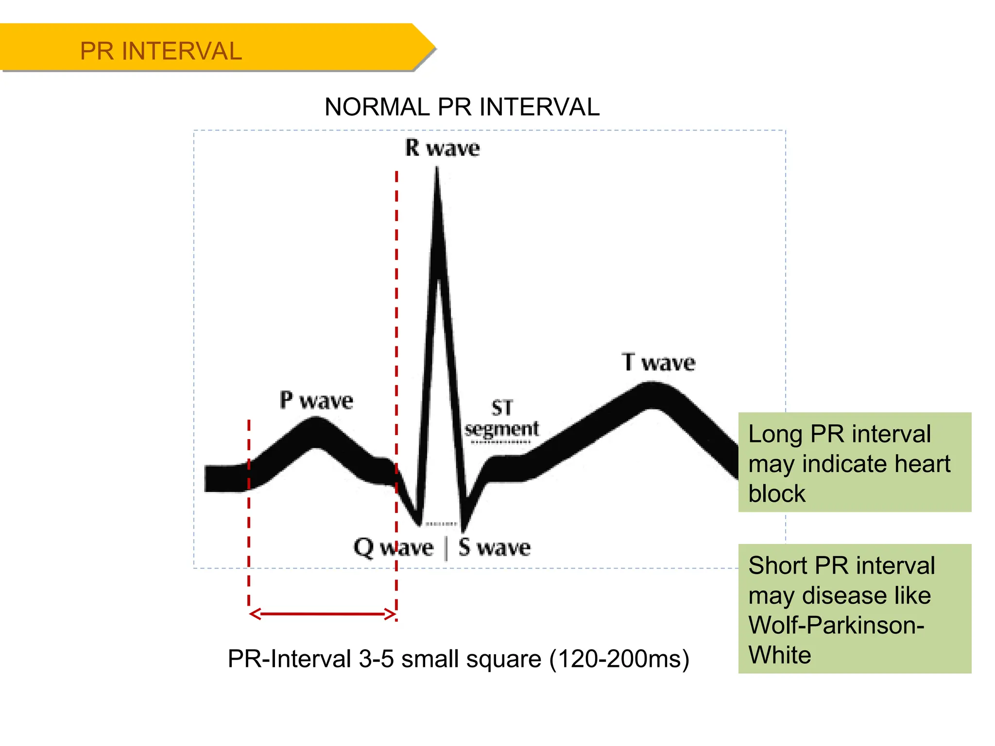 PR INTERVAL
NORMAL PR INTERVAL
PR-Interval 3-5 small square (120-200ms)
Long PR interval
may indicate heart
block
Short PR interval
may disease like
Wolf-Parkinson-
White
 