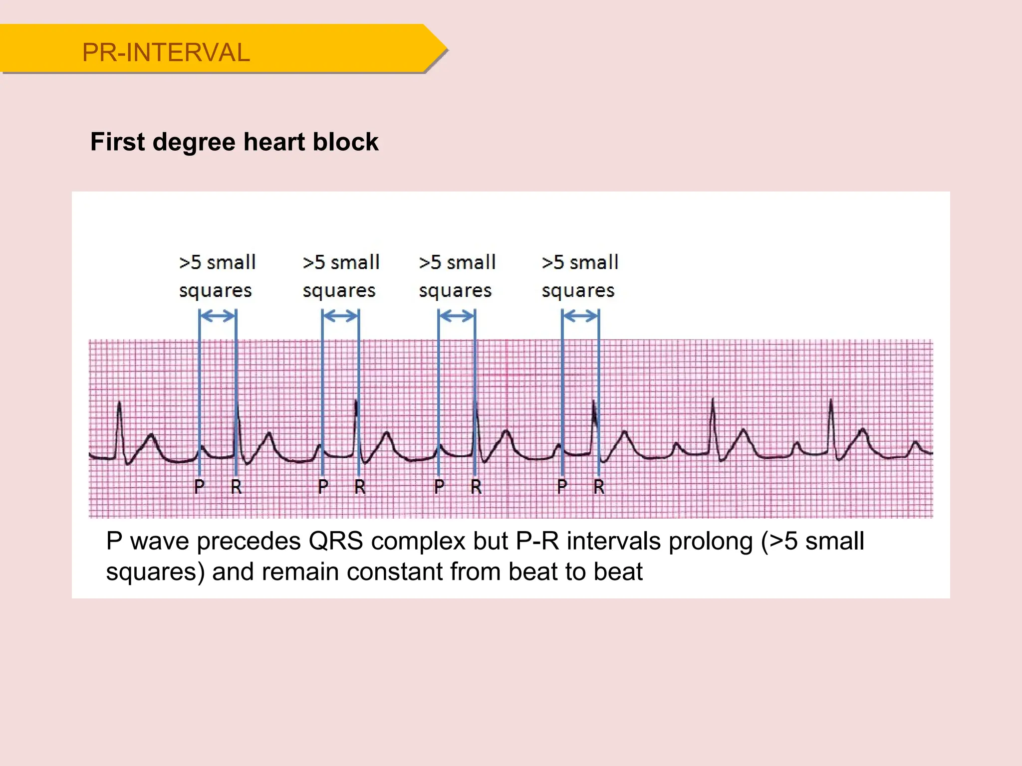 PR-INTERVAL
First degree heart block
P wave precedes QRS complex but P-R intervals prolong (>5 small
squares) and remain constant from beat to beat
 