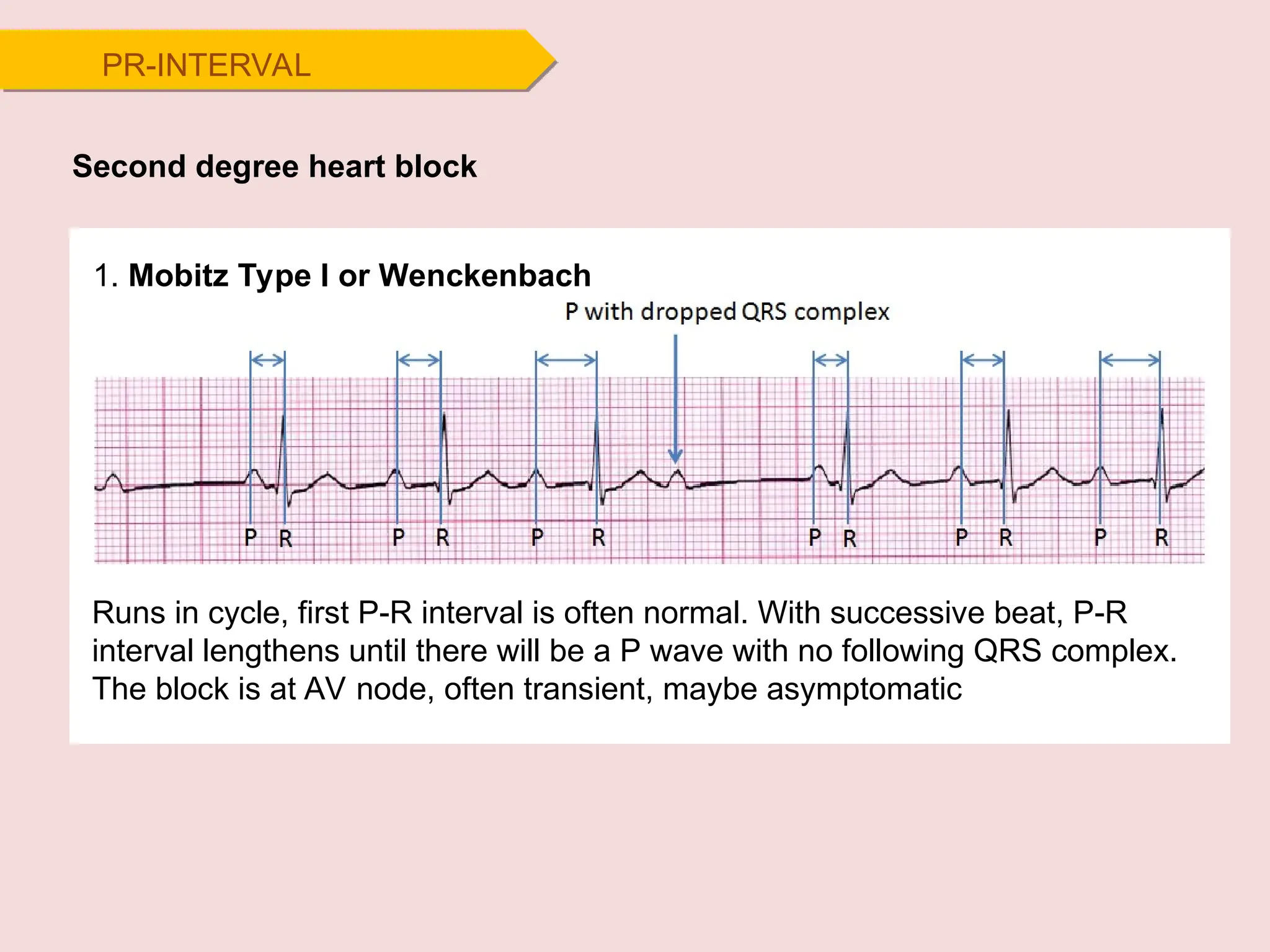 Second degree heart block
1. Mobitz Type I or Wenckenbach
Runs in cycle, first P-R interval is often normal. With successive beat, P-R
interval lengthens until there will be a P wave with no following QRS complex.
The block is at AV node, often transient, maybe asymptomatic
PR-INTERVAL
 