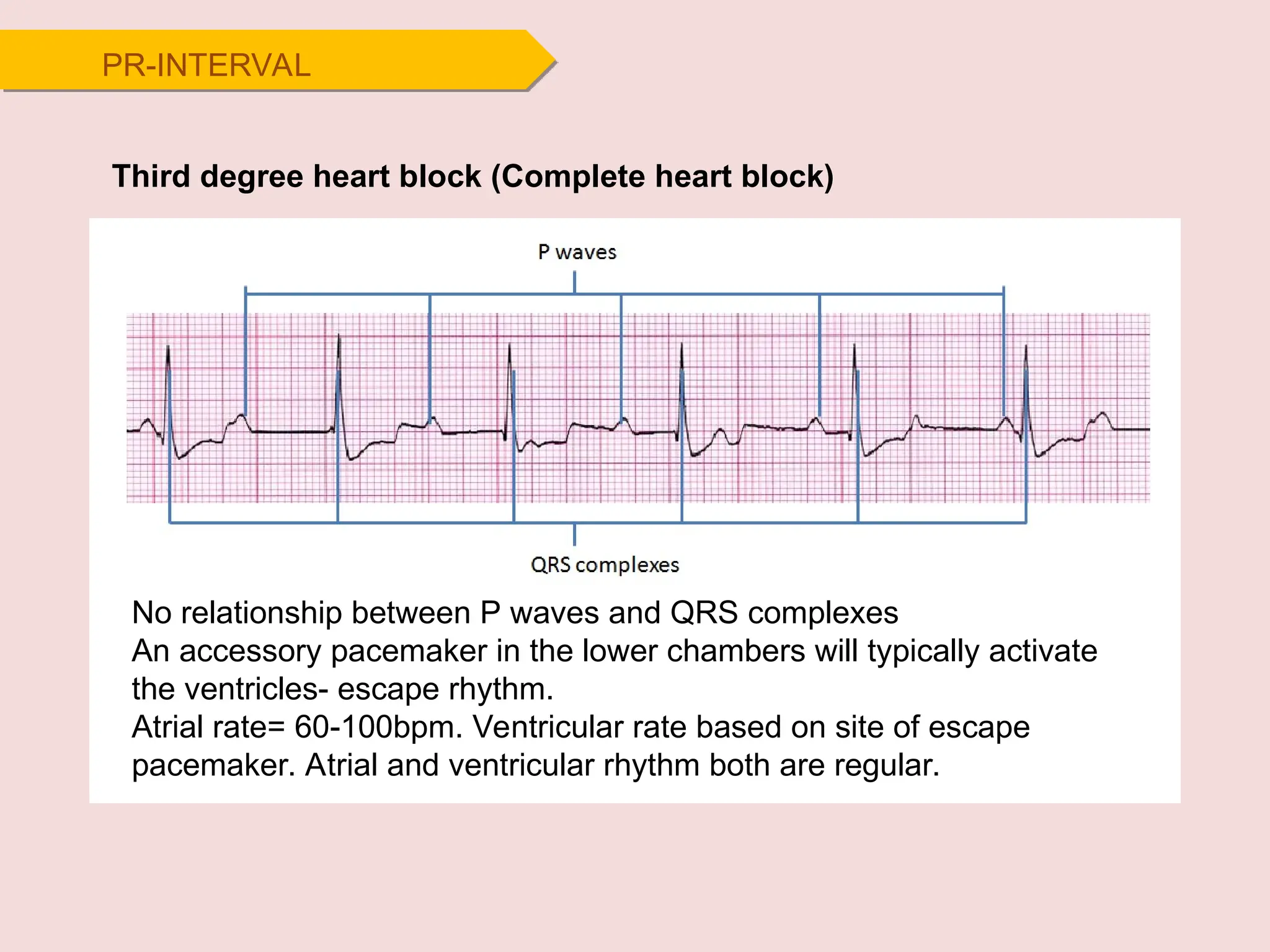 Third degree heart block (Complete heart block)
No relationship between P waves and QRS complexes
An accessory pacemaker in the lower chambers will typically activate
the ventricles- escape rhythm.
Atrial rate= 60-100bpm. Ventricular rate based on site of escape
pacemaker. Atrial and ventricular rhythm both are regular.
PR-INTERVAL
 