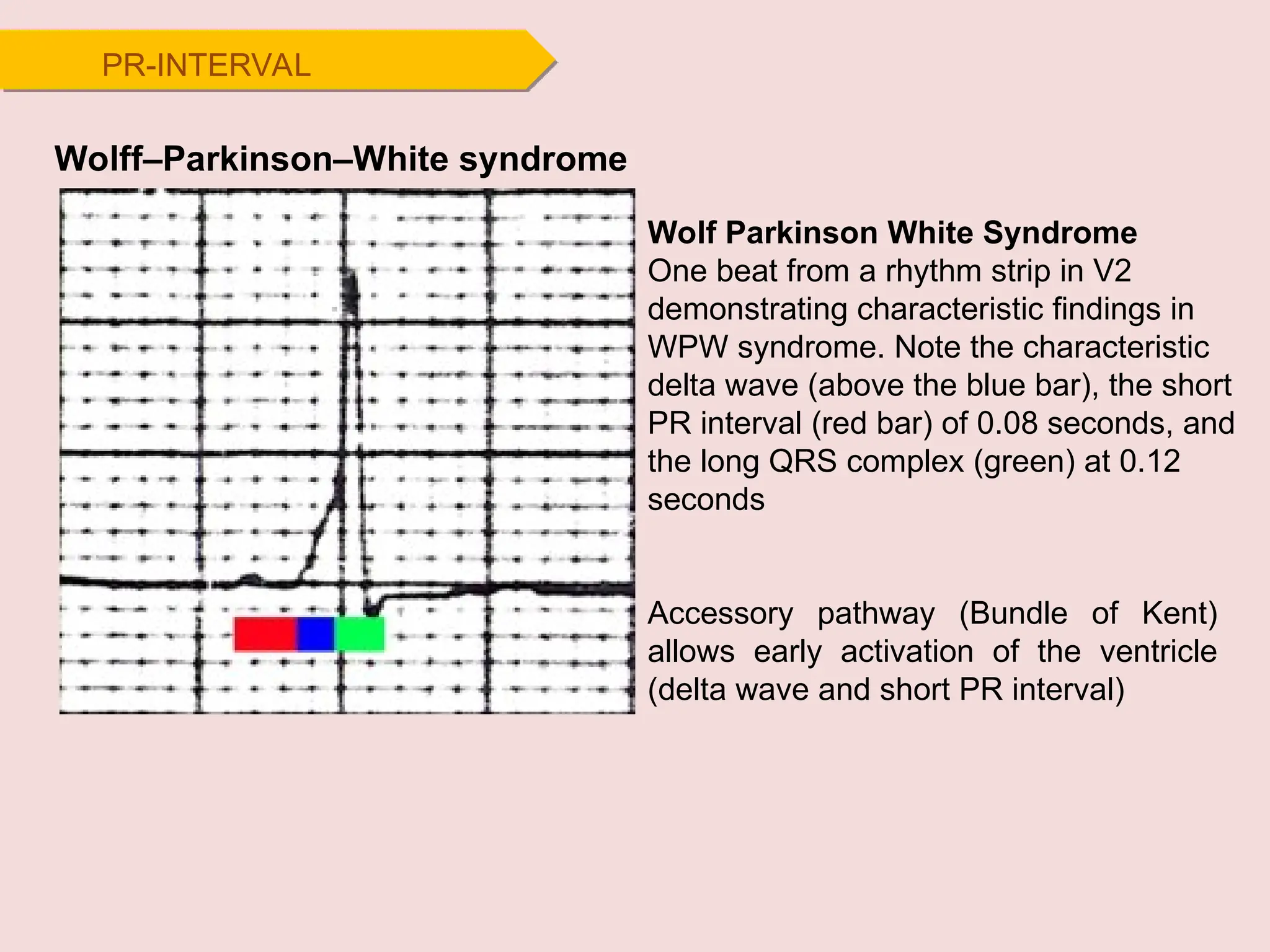 PR-INTERVAL
Wolff–Parkinson–White syndrome
Accessory pathway (Bundle of Kent)
allows early activation of the ventricle
(delta wave and short PR interval)
Wolf Parkinson White Syndrome
One beat from a rhythm strip in V2
demonstrating characteristic findings in
WPW syndrome. Note the characteristic
delta wave (above the blue bar), the short
PR interval (red bar) of 0.08 seconds, and
the long QRS complex (green) at 0.12
seconds
 