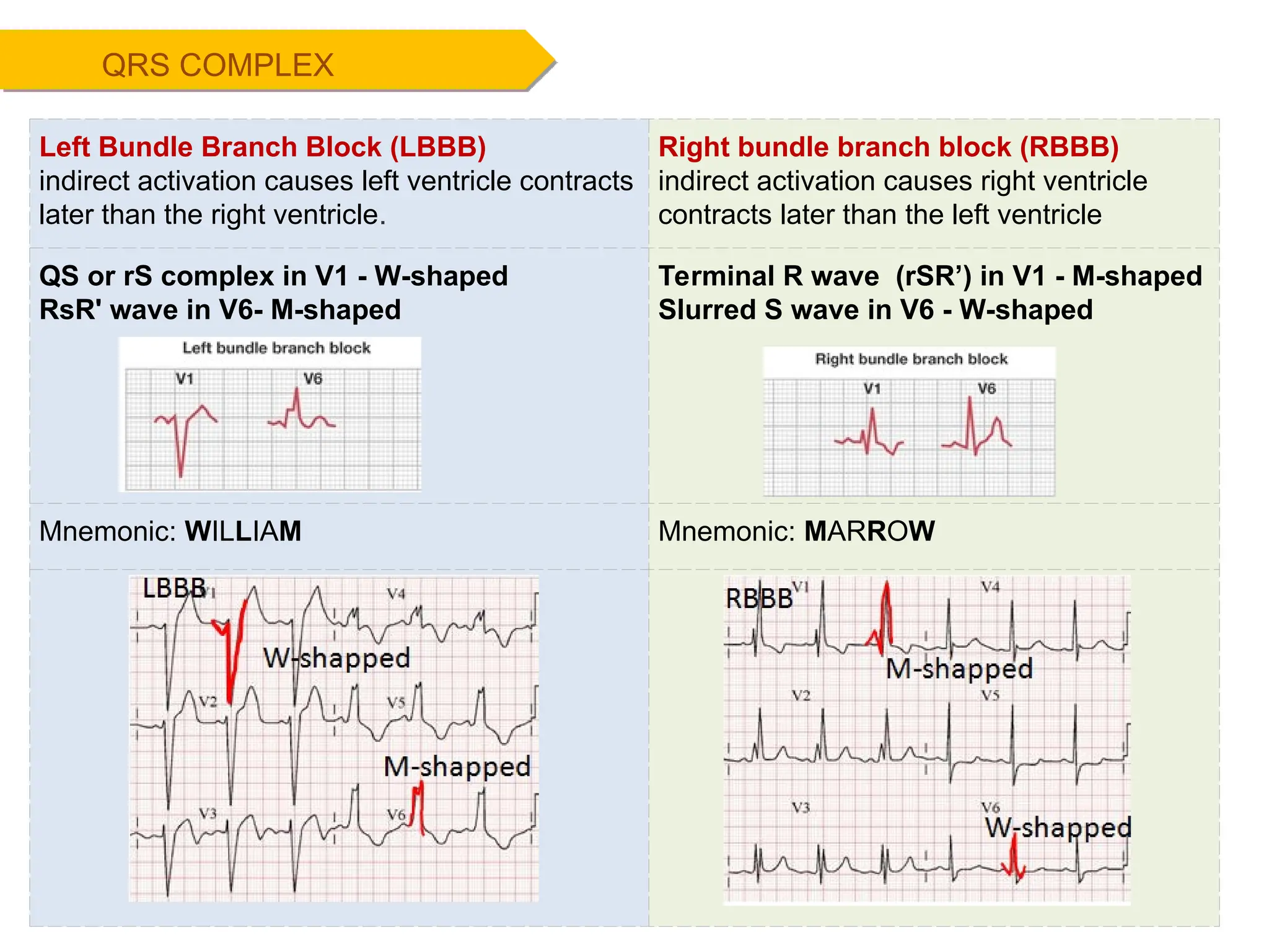 QRS COMPLEX
Left Bundle Branch Block (LBBB)
indirect activation causes left ventricle contracts
later than the right ventricle.
Right bundle branch block (RBBB)
indirect activation causes right ventricle
contracts later than the left ventricle
QS or rS complex in V1 - W-shaped
RsR' wave in V6- M-shaped
Terminal R wave (rSR’) in V1 - M-shaped
Slurred S wave in V6 - W-shaped
Mnemonic: WILLIAM Mnemonic: MARROW
 