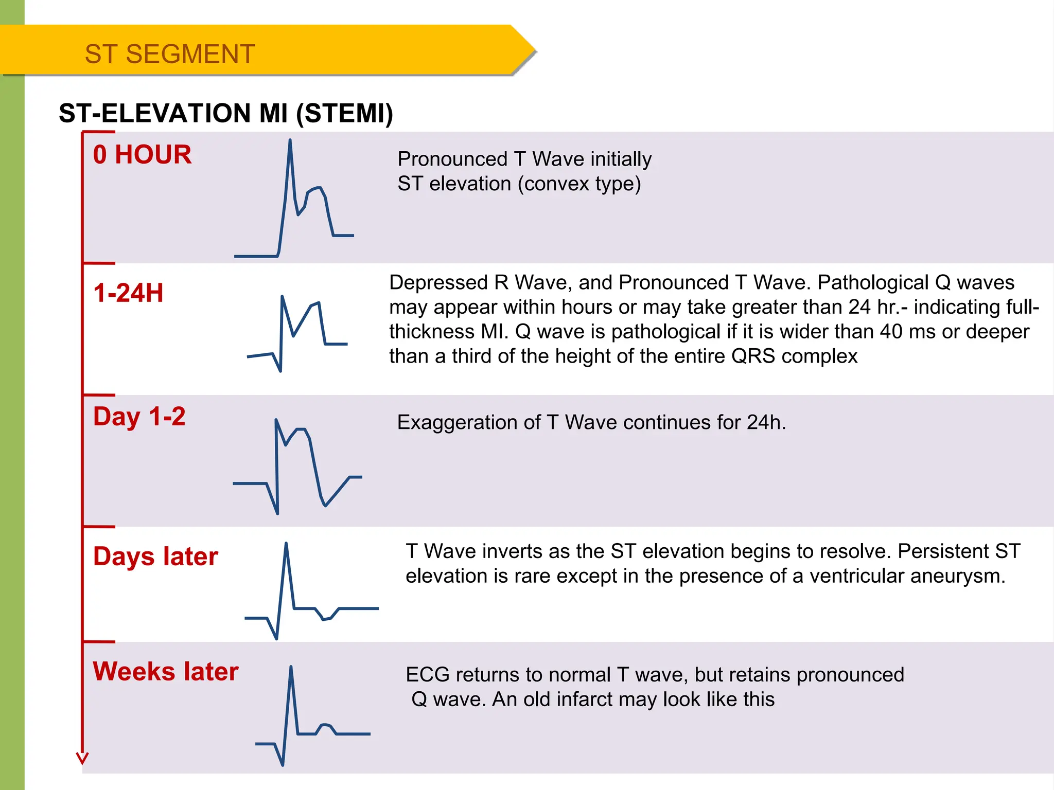 ST SEGMENT
ST-ELEVATION MI (STEMI)
0 HOUR
1-24H
Day 1-2
Days later
Weeks later
Pronounced T Wave initially
ST elevation (convex type)
Depressed R Wave, and Pronounced T Wave. Pathological Q waves
may appear within hours or may take greater than 24 hr.- indicating full-
thickness MI. Q wave is pathological if it is wider than 40 ms or deeper
than a third of the height of the entire QRS complex
Exaggeration of T Wave continues for 24h.
T Wave inverts as the ST elevation begins to resolve. Persistent ST
elevation is rare except in the presence of a ventricular aneurysm.
ECG returns to normal T wave, but retains pronounced
Q wave. An old infarct may look like this
 