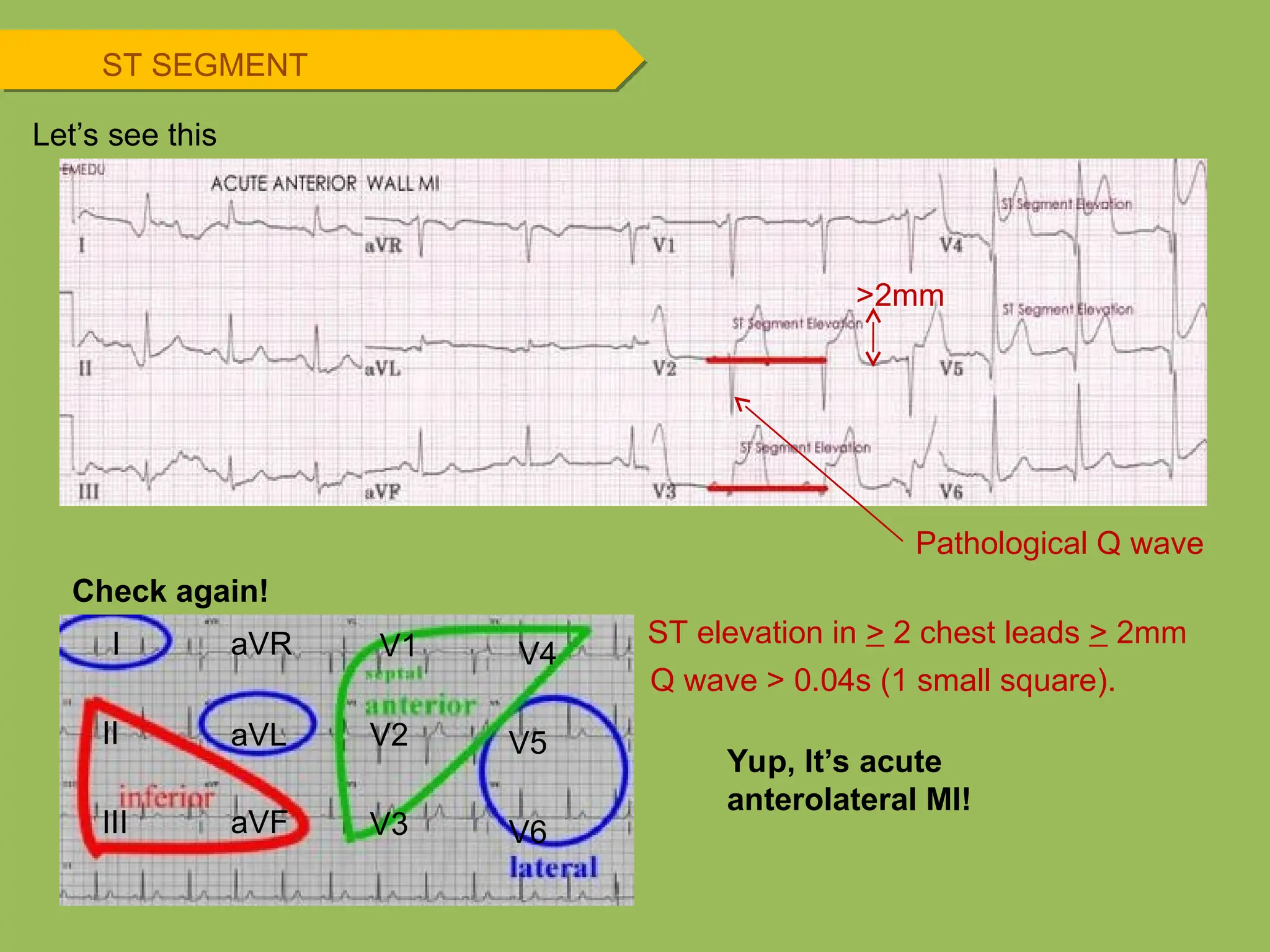 I
II
III
aVR
aVL
aVF
V1
V2
V3
V4
V5
V6
Check again!
>2mm
Yup, It’s acute
anterolateral MI!
Let’s see this
ST elevation in > 2 chest leads > 2mm
Pathological Q wave
Q wave > 0.04s (1 small square).
ST SEGMENT
 