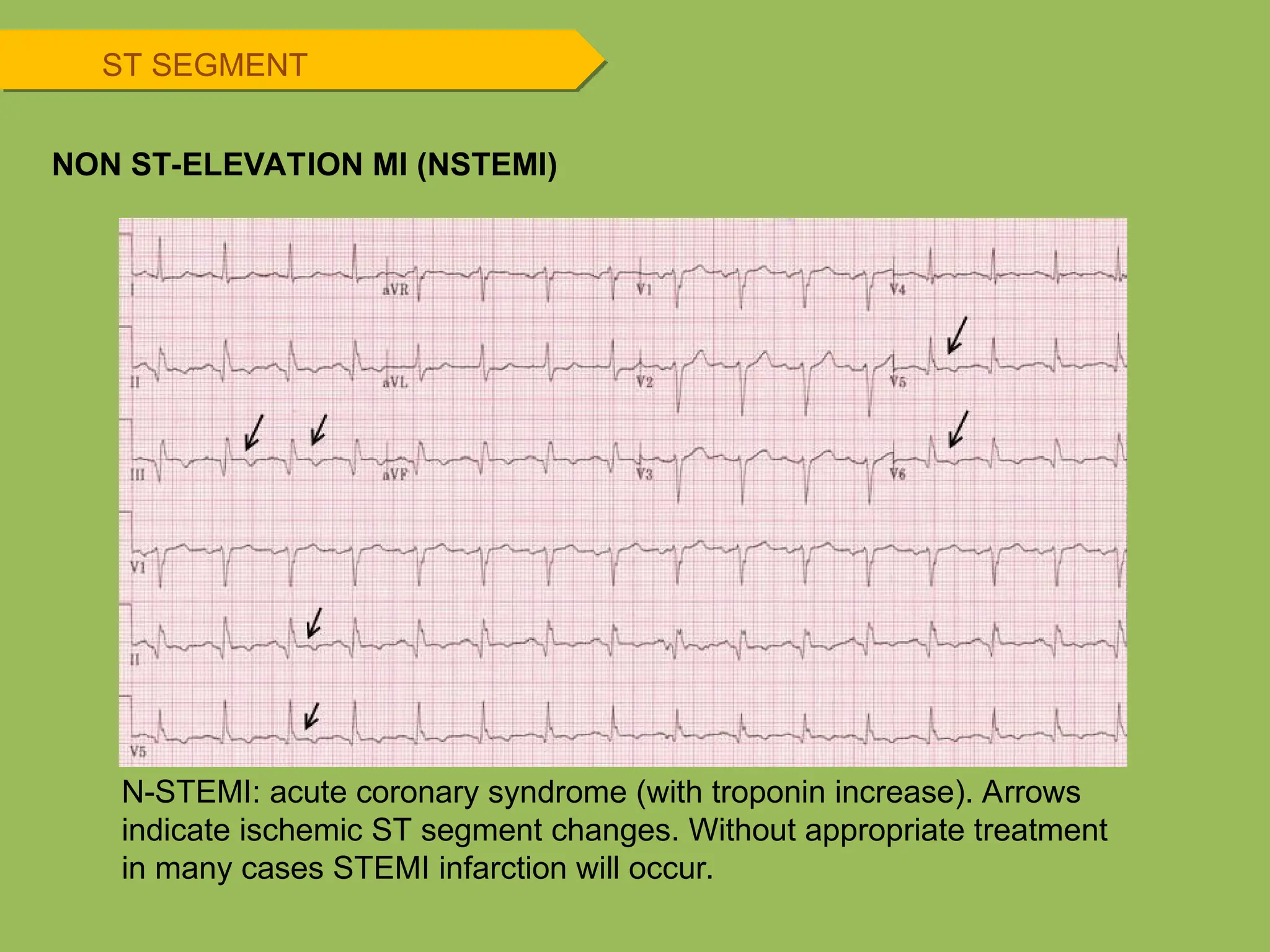 ST SEGMENT
NON ST-ELEVATION MI (NSTEMI)
N-STEMI: acute coronary syndrome (with troponin increase). Arrows
indicate ischemic ST segment changes. Without appropriate treatment
in many cases STEMI infarction will occur.
 