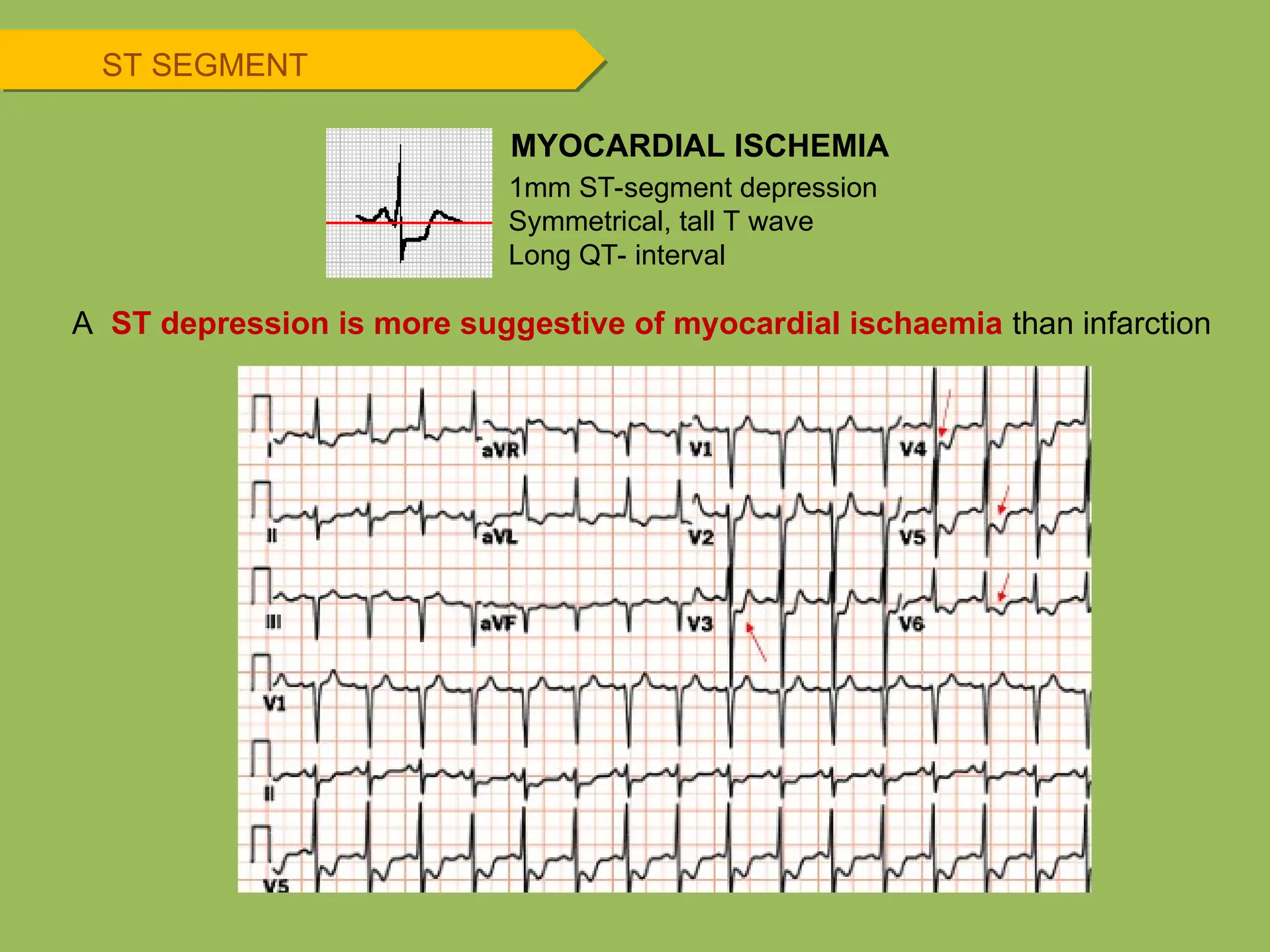 A ST depression is more suggestive of myocardial ischaemia than infarction
1mm ST-segment depression
Symmetrical, tall T wave
Long QT- interval
MYOCARDIAL ISCHEMIA
ST SEGMENT
 