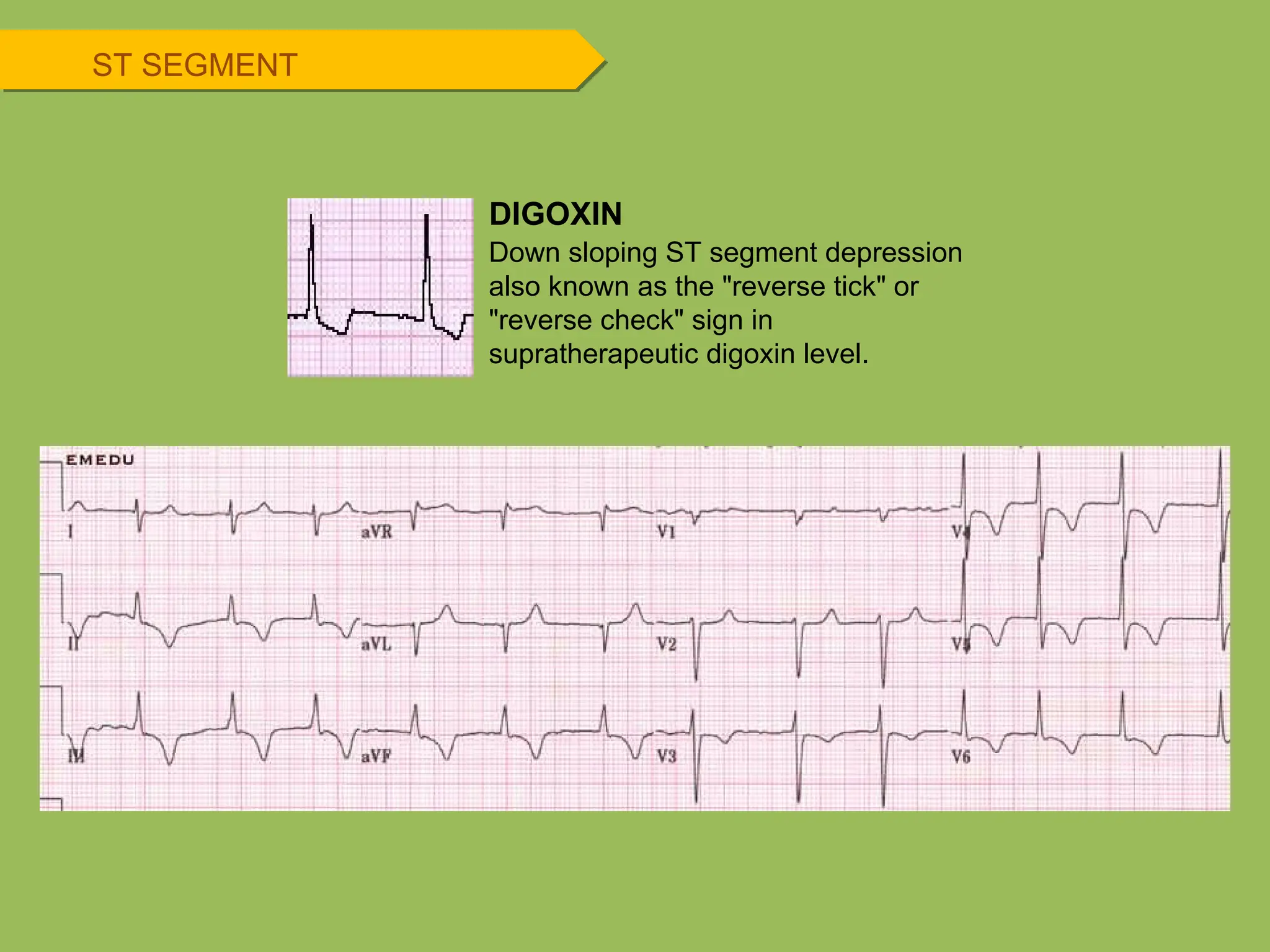 ST SEGMENT
DIGOXIN
Down sloping ST segment depression
also known as the "reverse tick" or
"reverse check" sign in
supratherapeutic digoxin level.
 