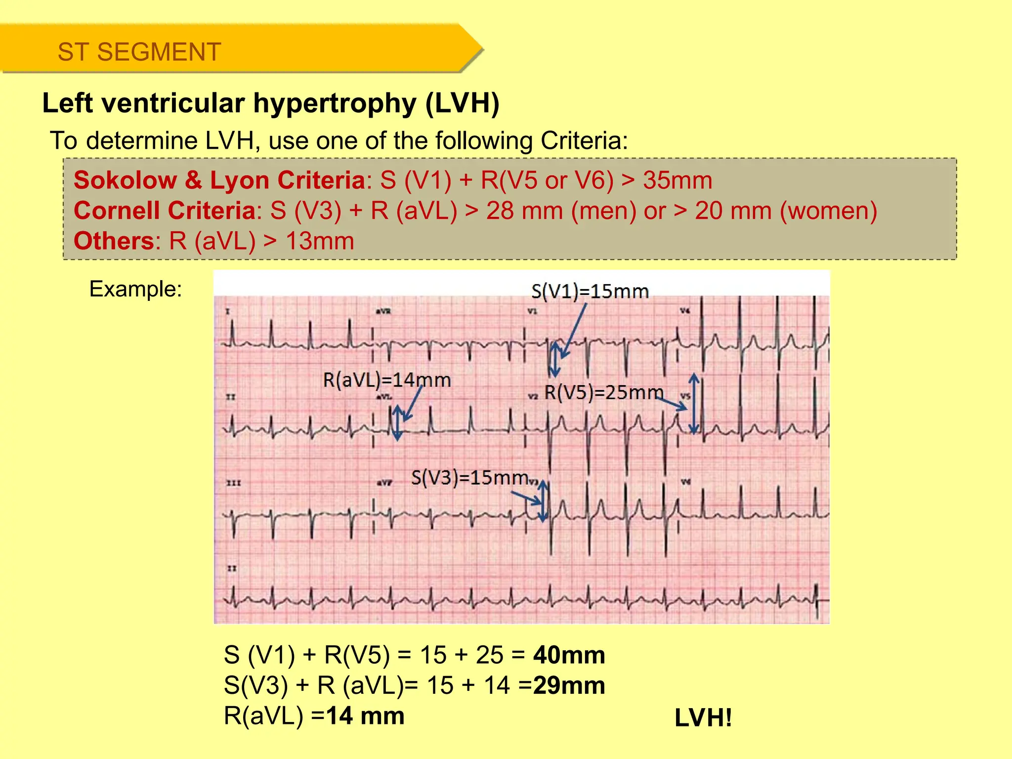 ST SEGMENT
Left ventricular hypertrophy (LVH)
Example:
Sokolow & Lyon Criteria: S (V1) + R(V5 or V6) > 35mm
Cornell Criteria: S (V3) + R (aVL) > 28 mm (men) or > 20 mm (women)
Others: R (aVL) > 13mm
S (V1) + R(V5) = 15 + 25 = 40mm
S(V3) + R (aVL)= 15 + 14 =29mm
R(aVL) =14 mm LVH!
To determine LVH, use one of the following Criteria:
 