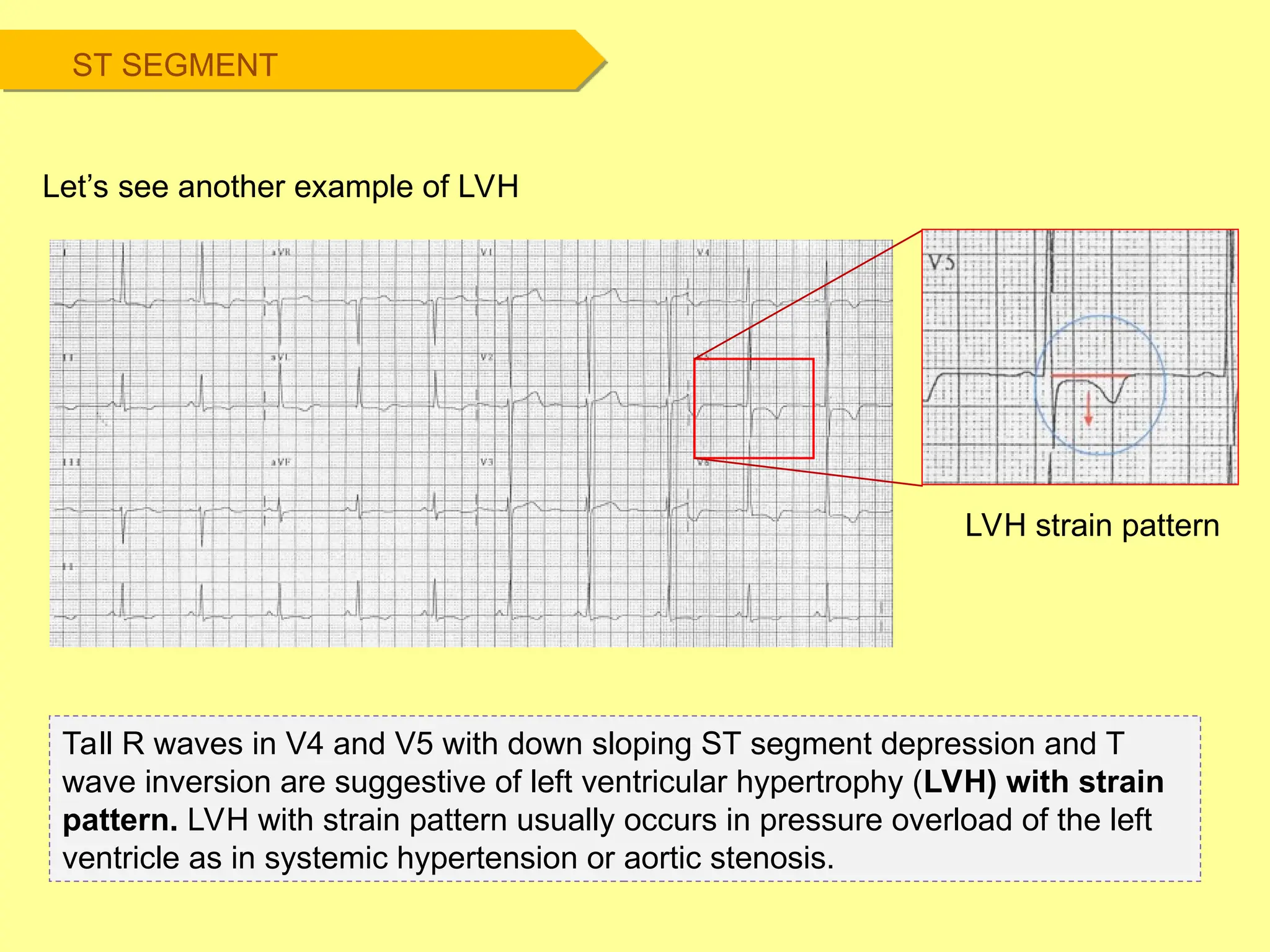 Tall R waves in V4 and V5 with down sloping ST segment depression and T
wave inversion are suggestive of left ventricular hypertrophy (LVH) with strain
pattern. LVH with strain pattern usually occurs in pressure overload of the left
ventricle as in systemic hypertension or aortic stenosis.
Let’s see another example of LVH
LVH strain pattern
ST SEGMENT
 
