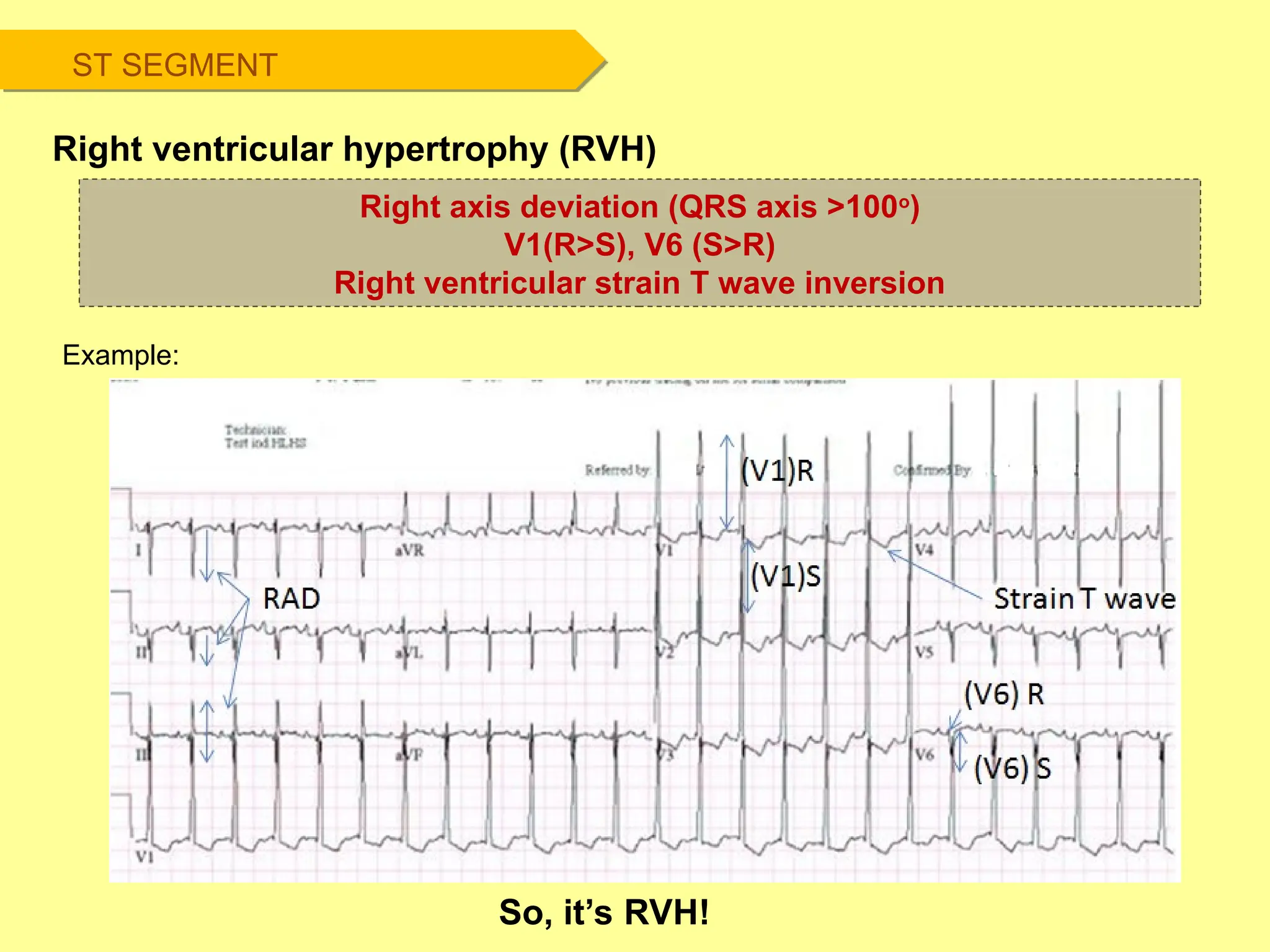 ST SEGMENT
Right ventricular hypertrophy (RVH)
Example:
Right axis deviation (QRS axis >100o
)
V1(R>S), V6 (S>R)
Right ventricular strain T wave inversion
So, it’s RVH!
 
